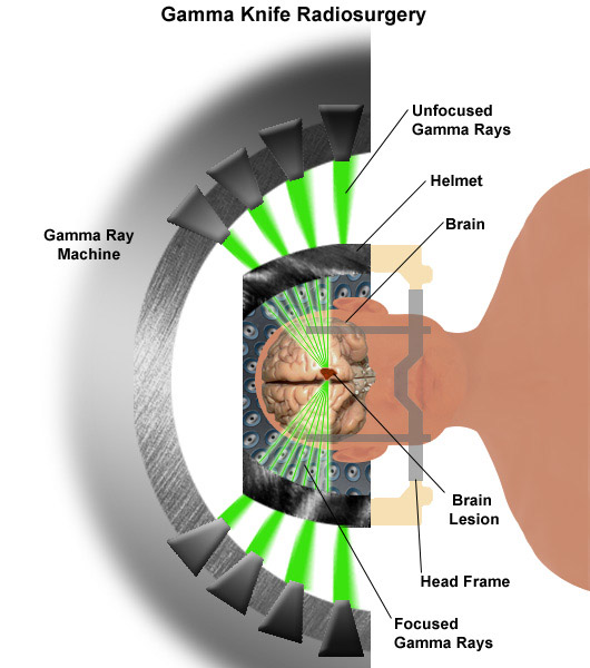Stereotactic Radiosurgery